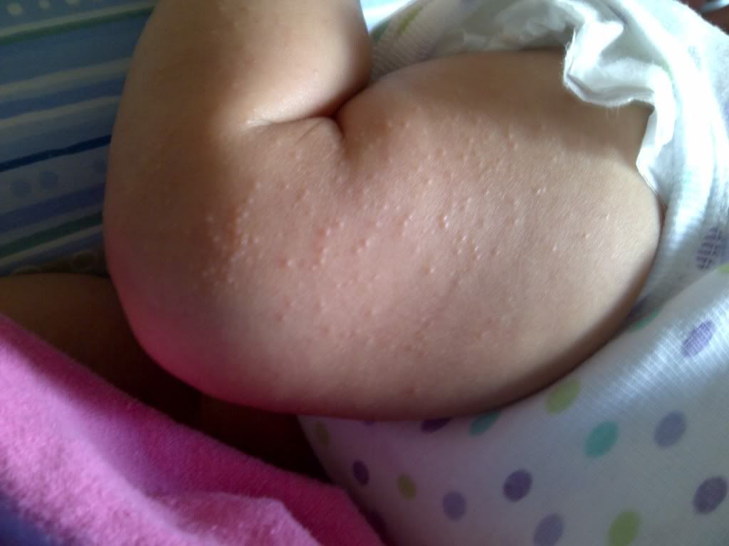 Peanut Rash