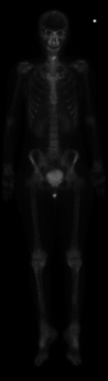 Bone Scan Front