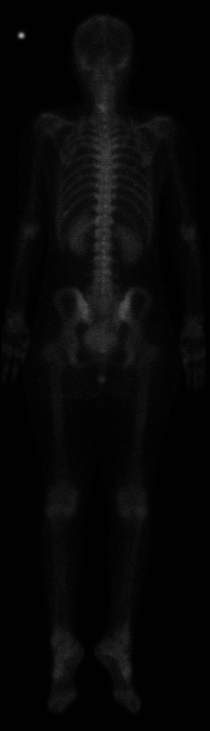 Bone Scan Back