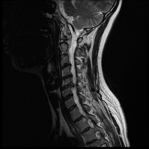 Cervical Spine MRI 1