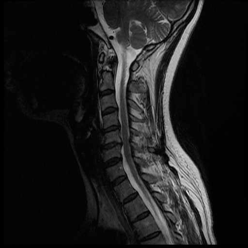 Cervical Spine MRI 2