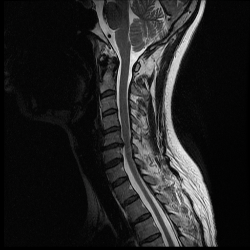 Cervical Spine MRI 3