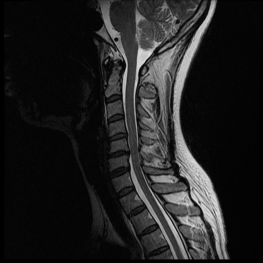 Cervical Spine MRI 4