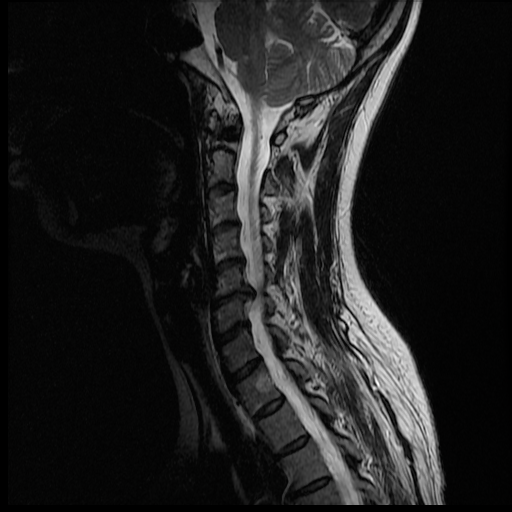 Cervical Spine MRI 5